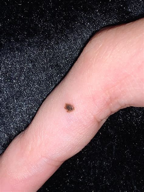 melanoma black spot on finger